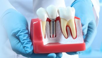 How Long After Tooth Extraction Can You Get an Implant?