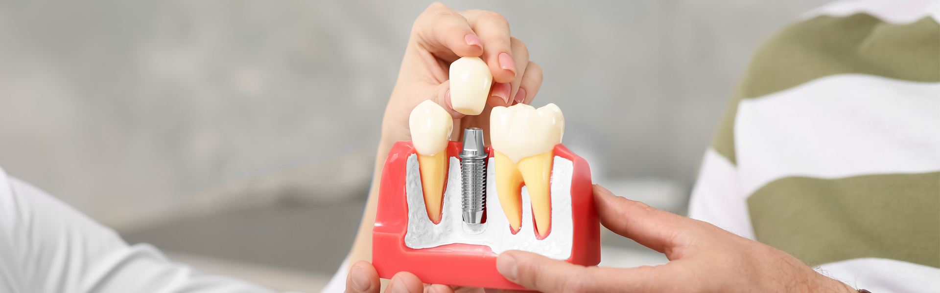4 Best Dental Implant Alternatives