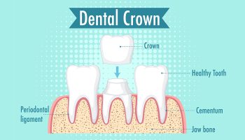 The Importance of Getting a Dental Crown When Needed