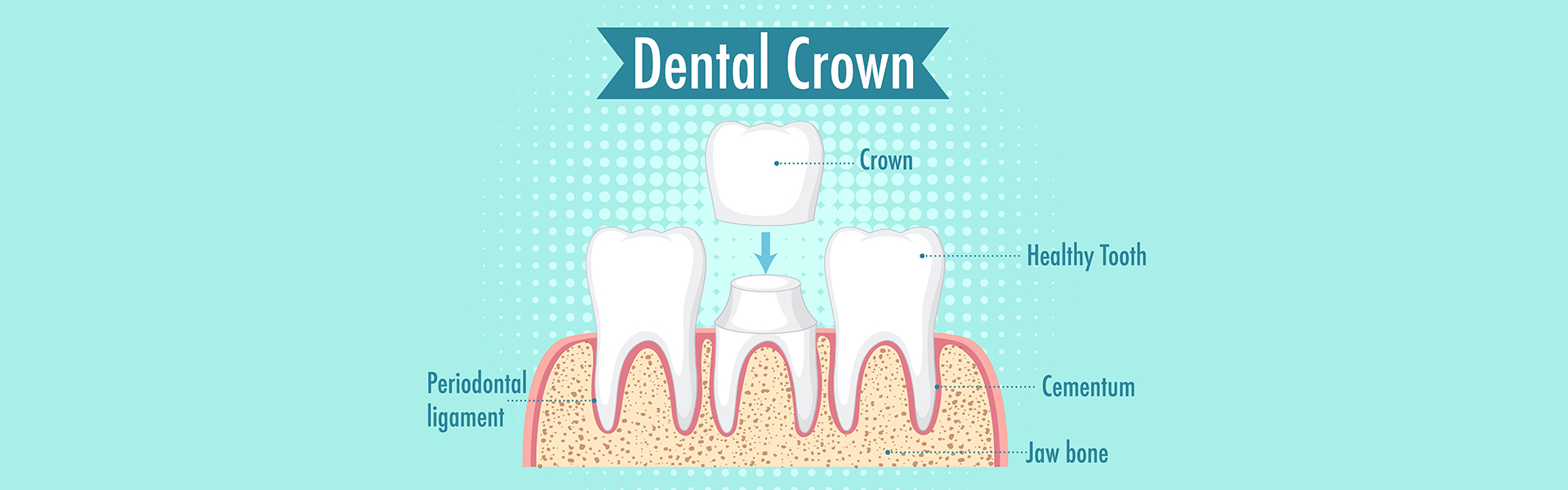The Importance of Getting a Dental Crown When Needed