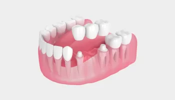 Transforming Smiles: Real Dental Bridge Success Stories from Gilbert, AZ