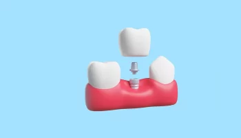 Do You Need a Bone Graft for Dental Implants in Gilbert?